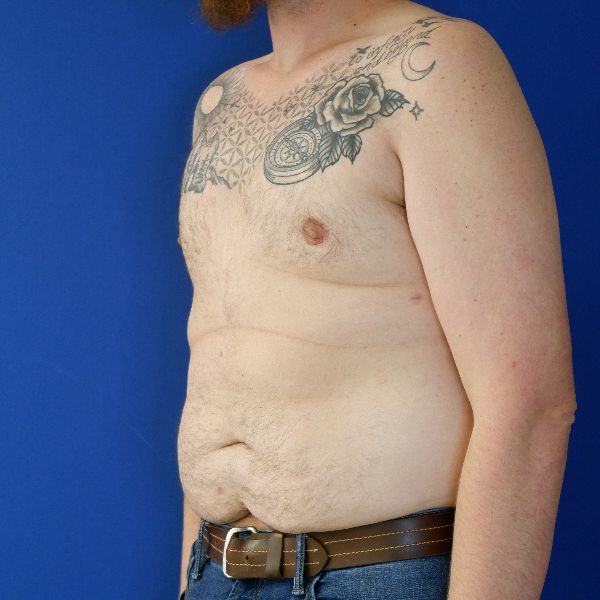 after gynecomastia left angle view male patient case 3695