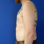 after gynecomastia left side view male patient case 3695