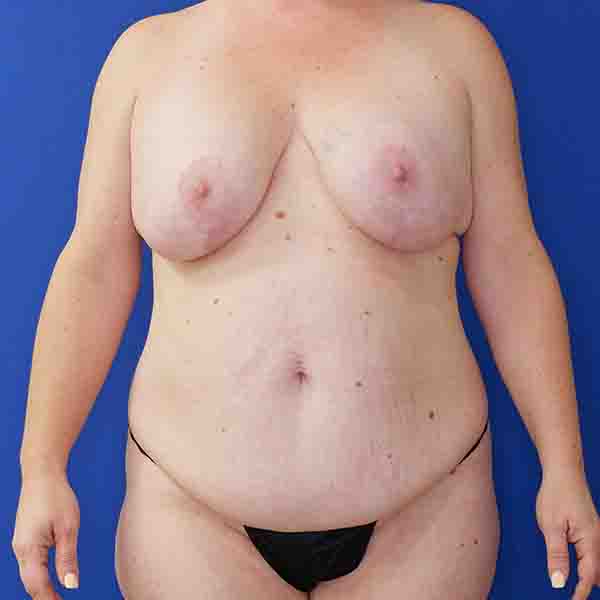 before mommy makeover front view female patient case 3674