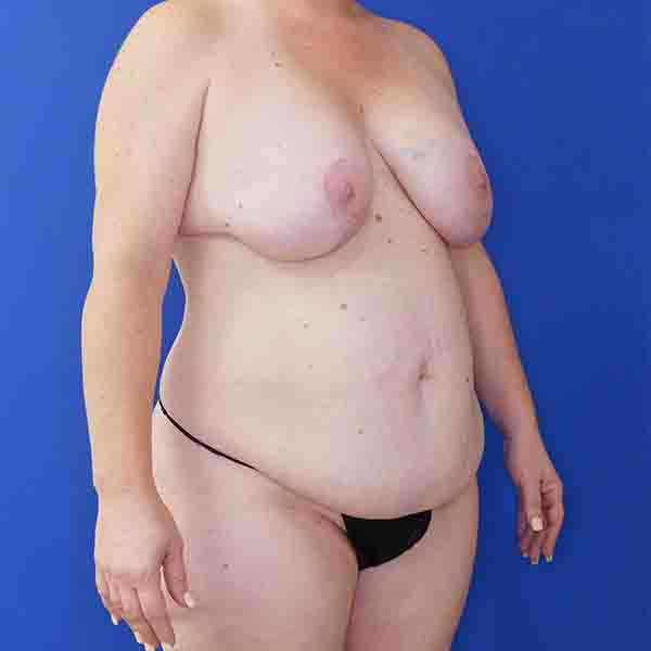 before mommy makeover right angle view female patient case 3674