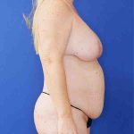 before mommy makeover right side view female patient case 3674