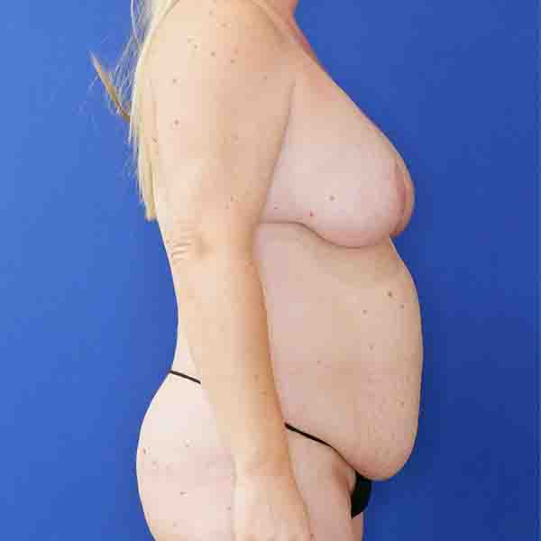 before mommy makeover right side view female patient case 3674