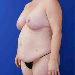 before mommy makeover left angle view female patient case 3674