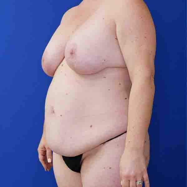 before mommy makeover left angle view female patient case 3674