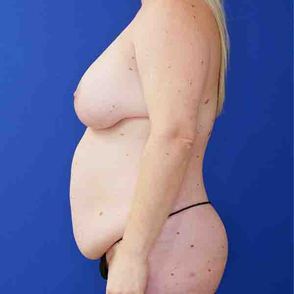 before mommy makeover left side view female patient case 3674