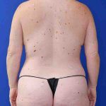 before mommy makeover back view female patient case 3674