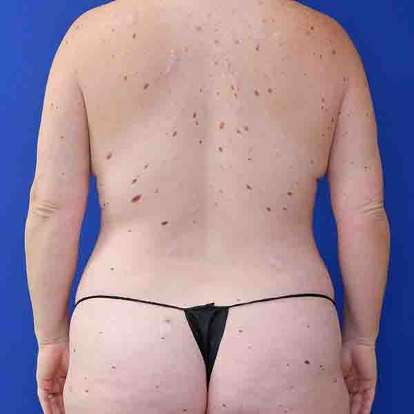 before mommy makeover back view female patient case 3674