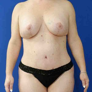 after mommy makeover front view female patient case 3674