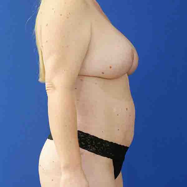 after mommy makeover right side view female patient case 3674