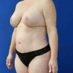 after mommy makeover left angle view female patient case 3674