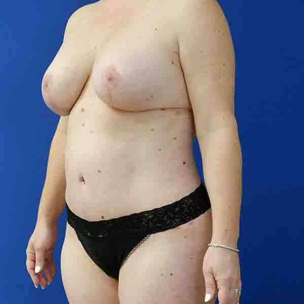after mommy makeover left angle view female patient case 3674