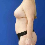 after mommy makeover left side view female patient case 3674