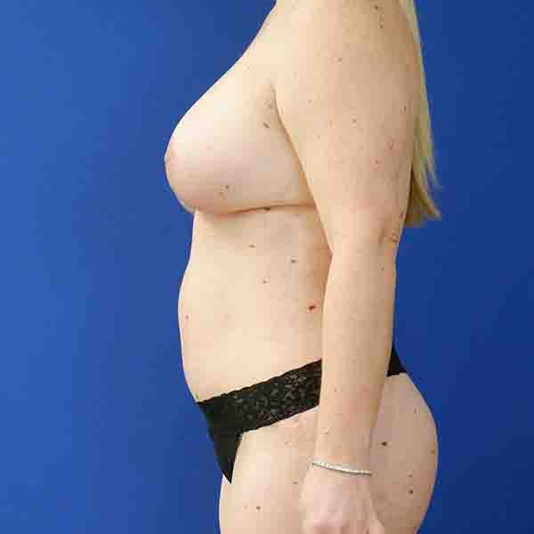 after mommy makeover left side view female patient case 3674