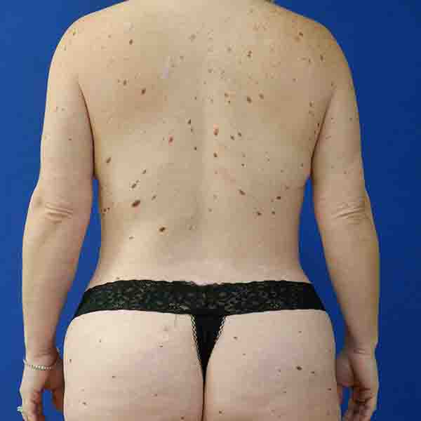 after mommy makeover back view female patient case 3674
