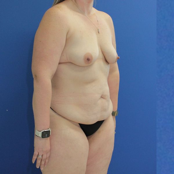 before mommy makeover right angle view female patient case 3688