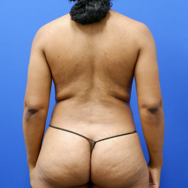 before breast augmentation with fat grafting back view female patient case 3760