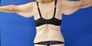 before arm lift arms out view of female patient 3827