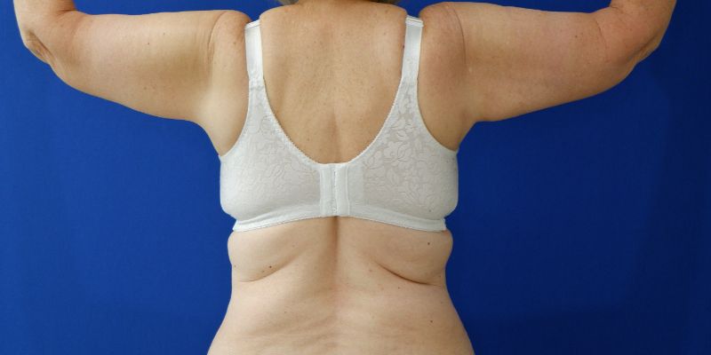 after arm lift arms up view of female patient 3827
