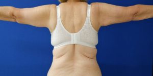 after arm lift arms out view of female patient 3827