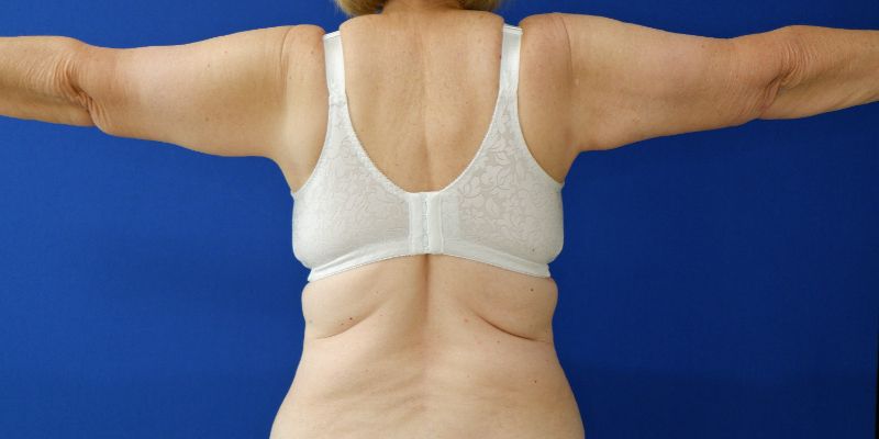 after arm lift arms out view of female patient 3827