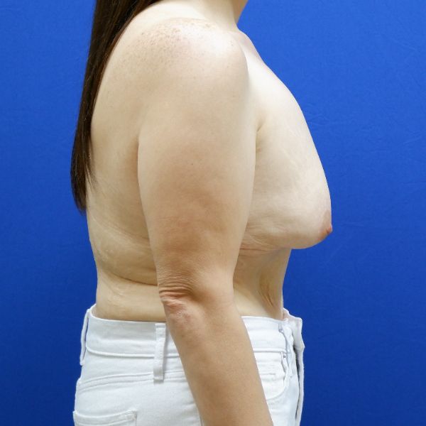 before breast lift with augmentation right side view female patient case 3926