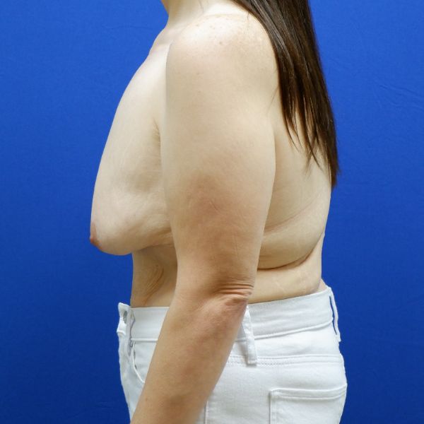 before breast lift with augmentation left side view female patient case 3926