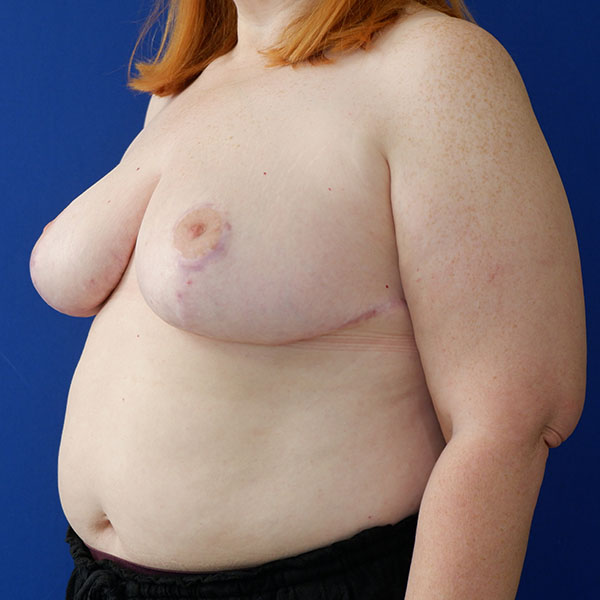 before breast lift with augmentation left angle view of female patient 3937