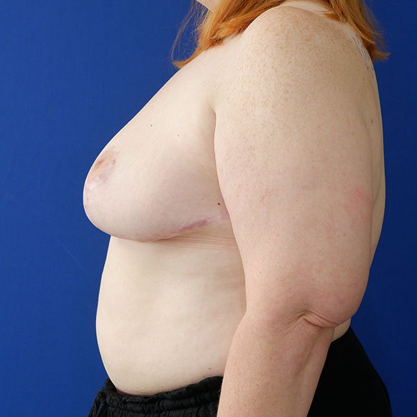 before breast lift with augmentation left side view of female patient 3937