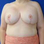 after breast lift with augmentation front view of female patient 3937