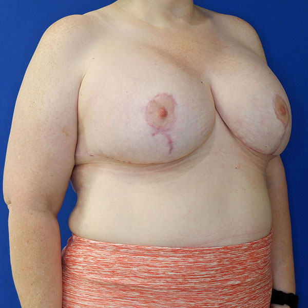 after breast lift with augmentation left angle view of female patient 3937