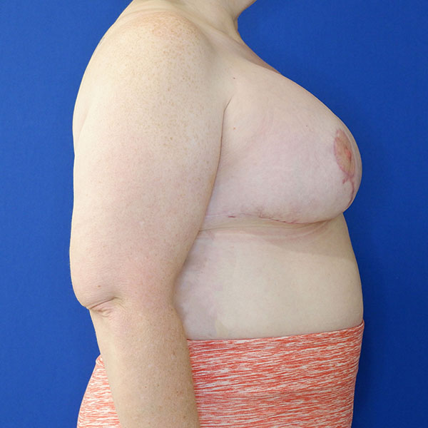 after breast lift with augmentation right side view of female patient 3937