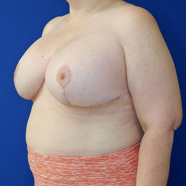 after breast lift with augmentation left angle view of female patient 3937