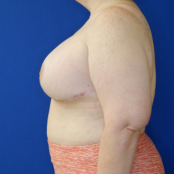 after breast lift with augmentation left side view of female patient 3937
