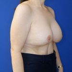 after breast lift with augmentation right angle view female patient case 3926