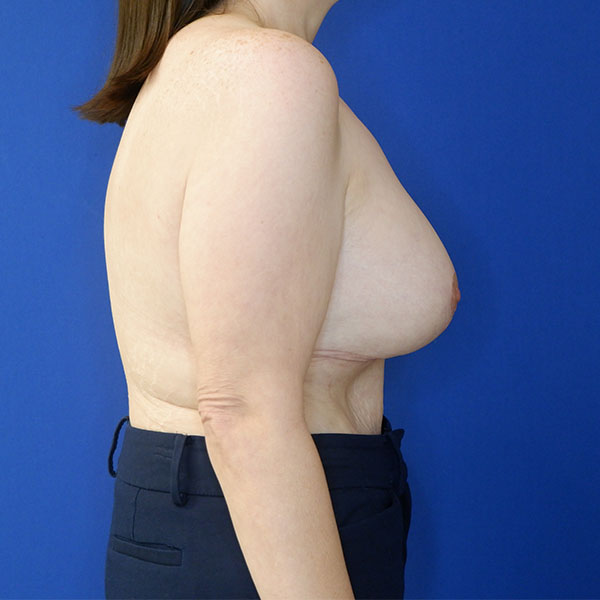 after breast lift with augmentation right side view female patient case 3926