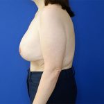after breast lift with augmentation left side view female patient case 3926