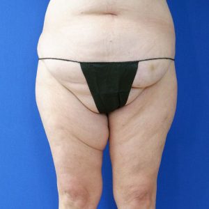 before liposuction lower legs front view female patient case 3998