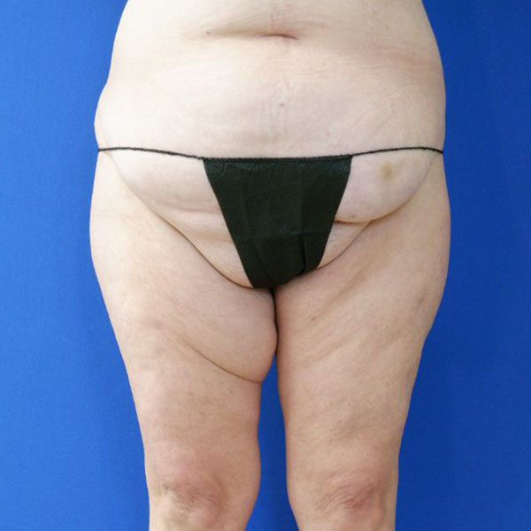 before liposuction lower legs front view female patient case 3998