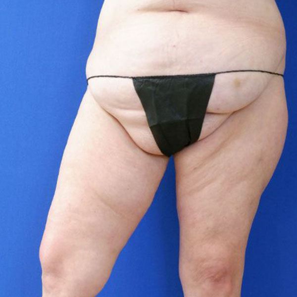 before liposuction lower open right leg view female patient case 3998