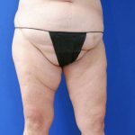 before liposuction lower open left leg view female patient case 3998