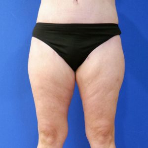 after liposuction lower legs front view female patient case 3998