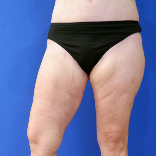 after liposuction lower open right leg view female patient case 3998