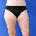 after liposuction lower open left leg view female patient case 3998
