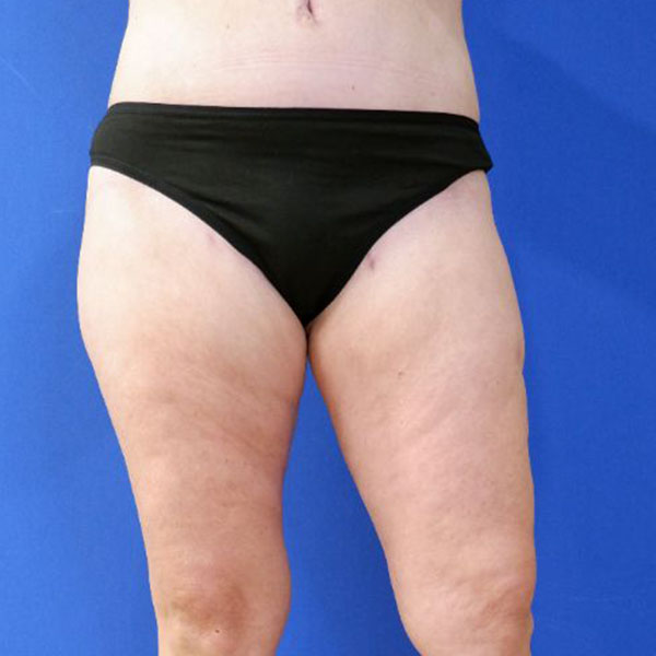 after liposuction lower open left leg view female patient case 3998