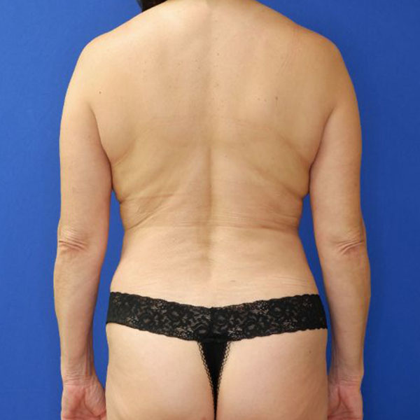 after liposuction back view female patient case 4080