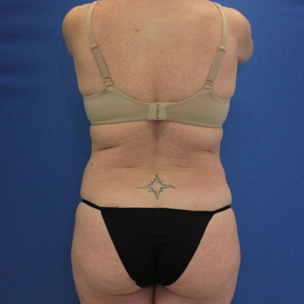 before liposuction back view female patient case 4086