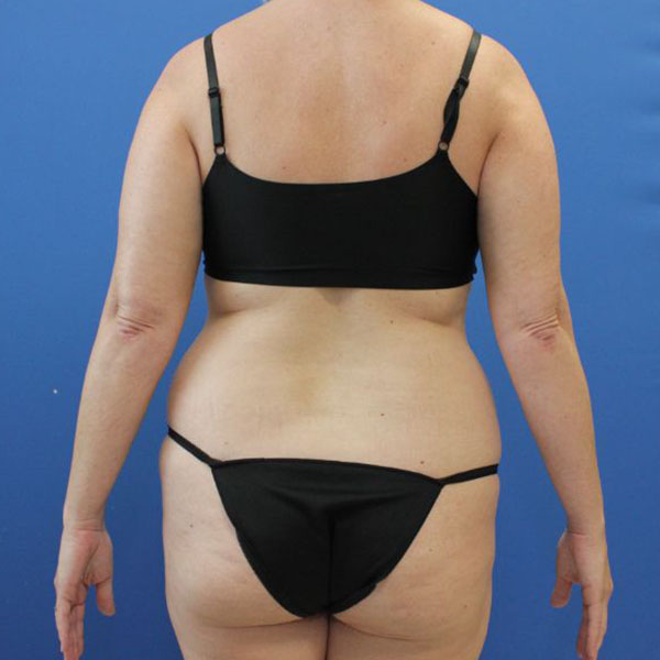 before liposuction back view female patient case 4089