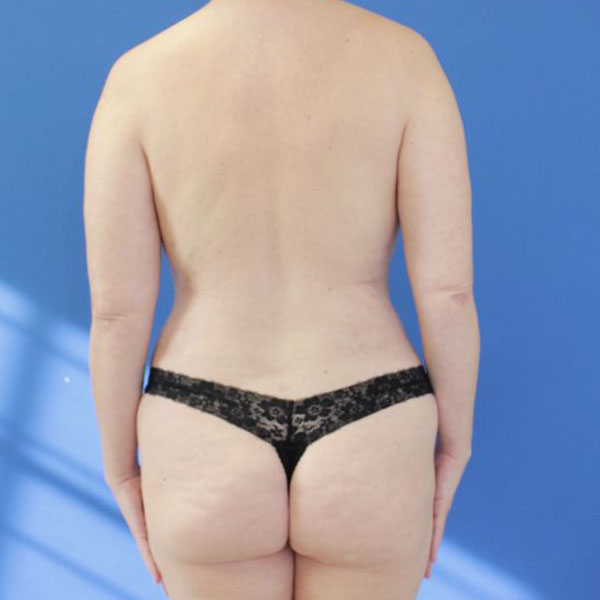after liposuction back view female patient case 4089