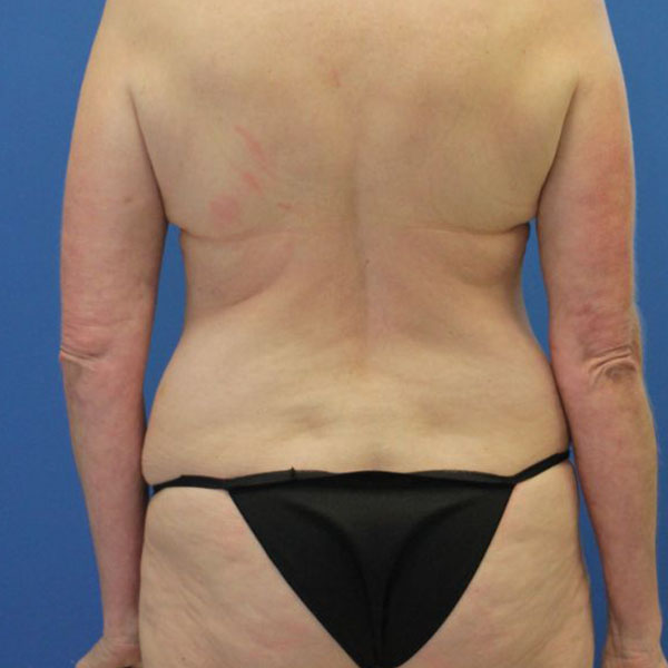 before liposuction back view female patient case 4092