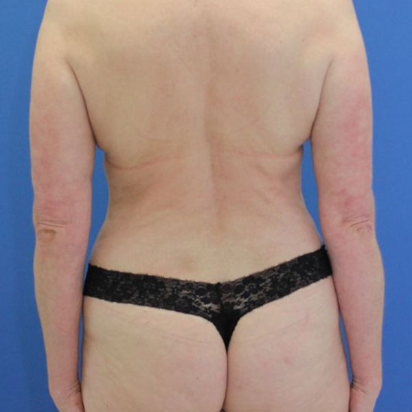 after liposuction back view female patient case 4092